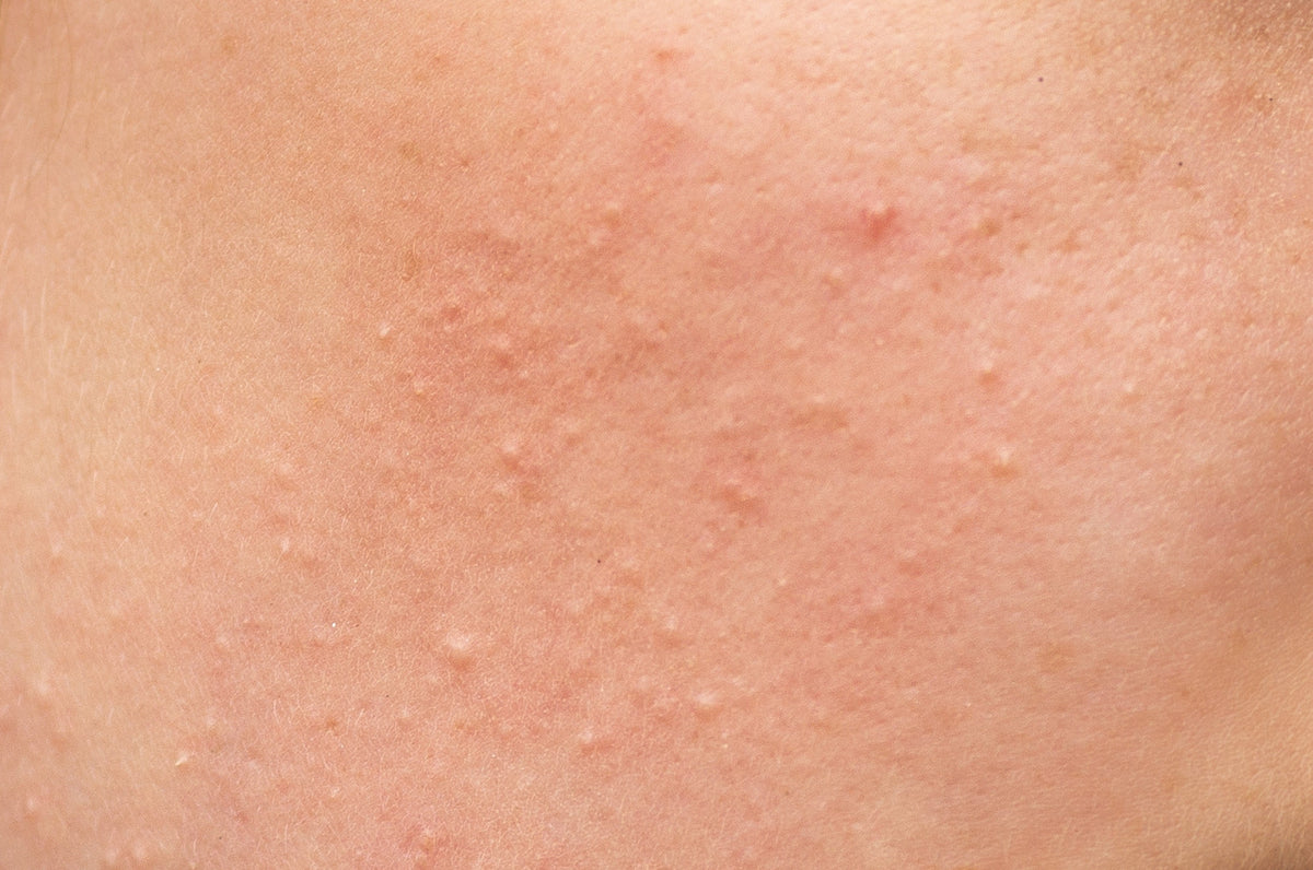 Protocollo Skincare Pelle Asfittica