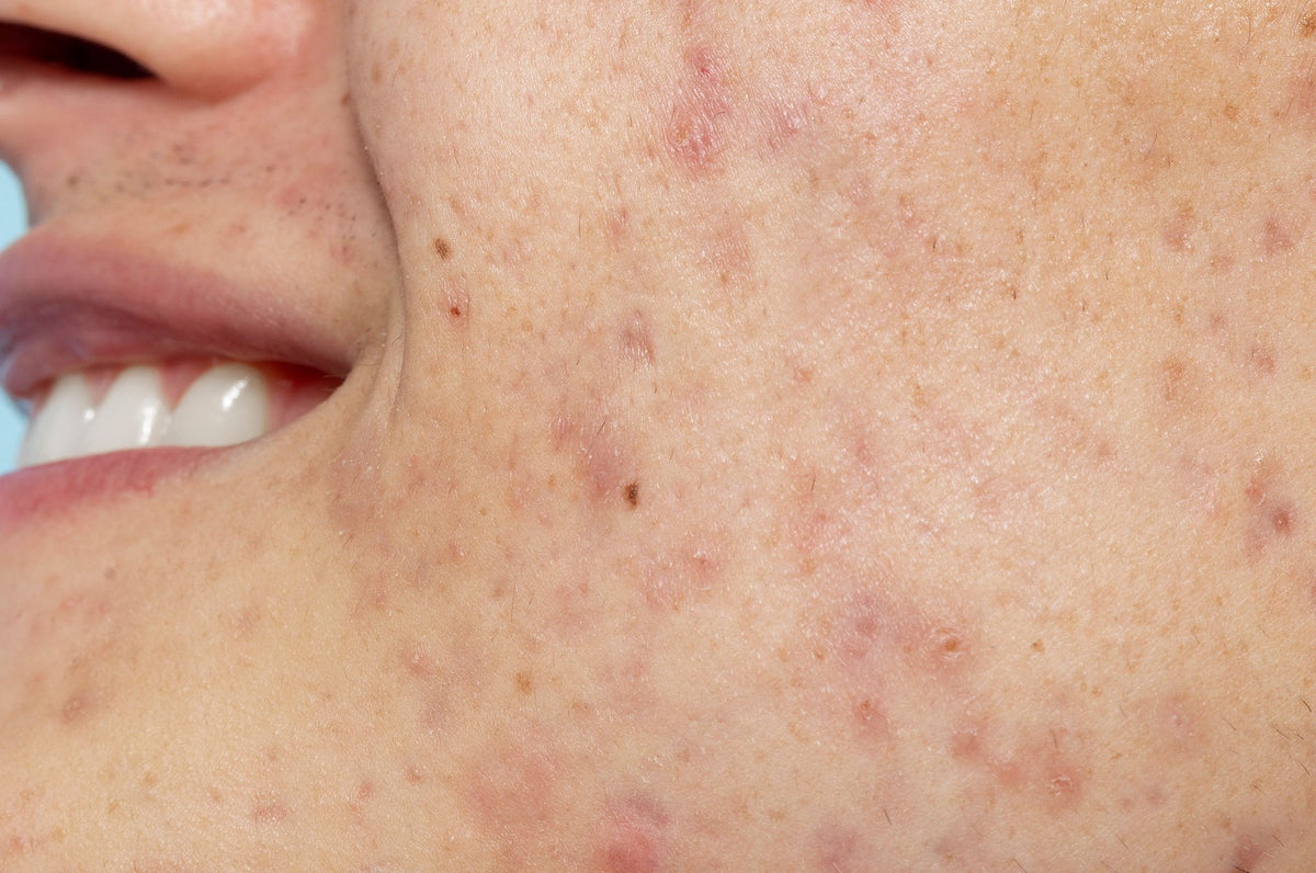 Protocollo Skincare per Macchie Post Acne