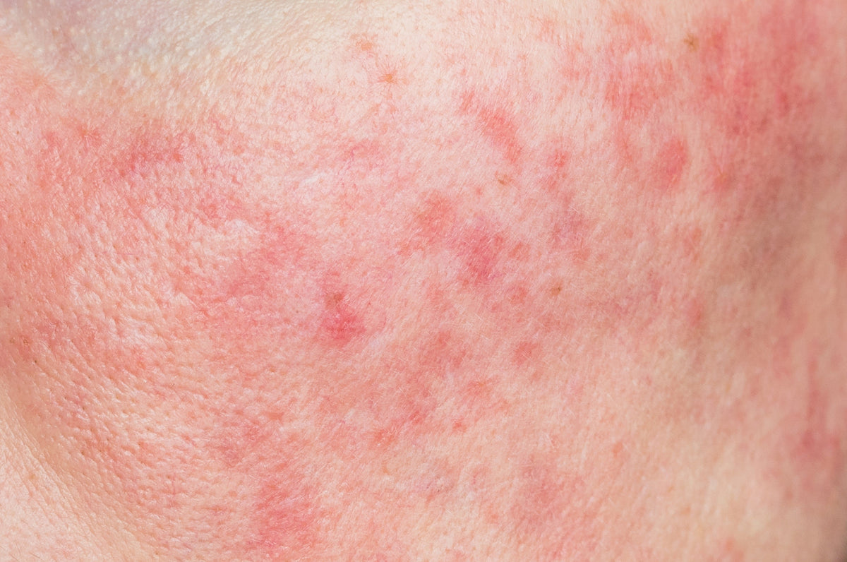 Protocollo Skincare Pelle Sensibile con Rossori