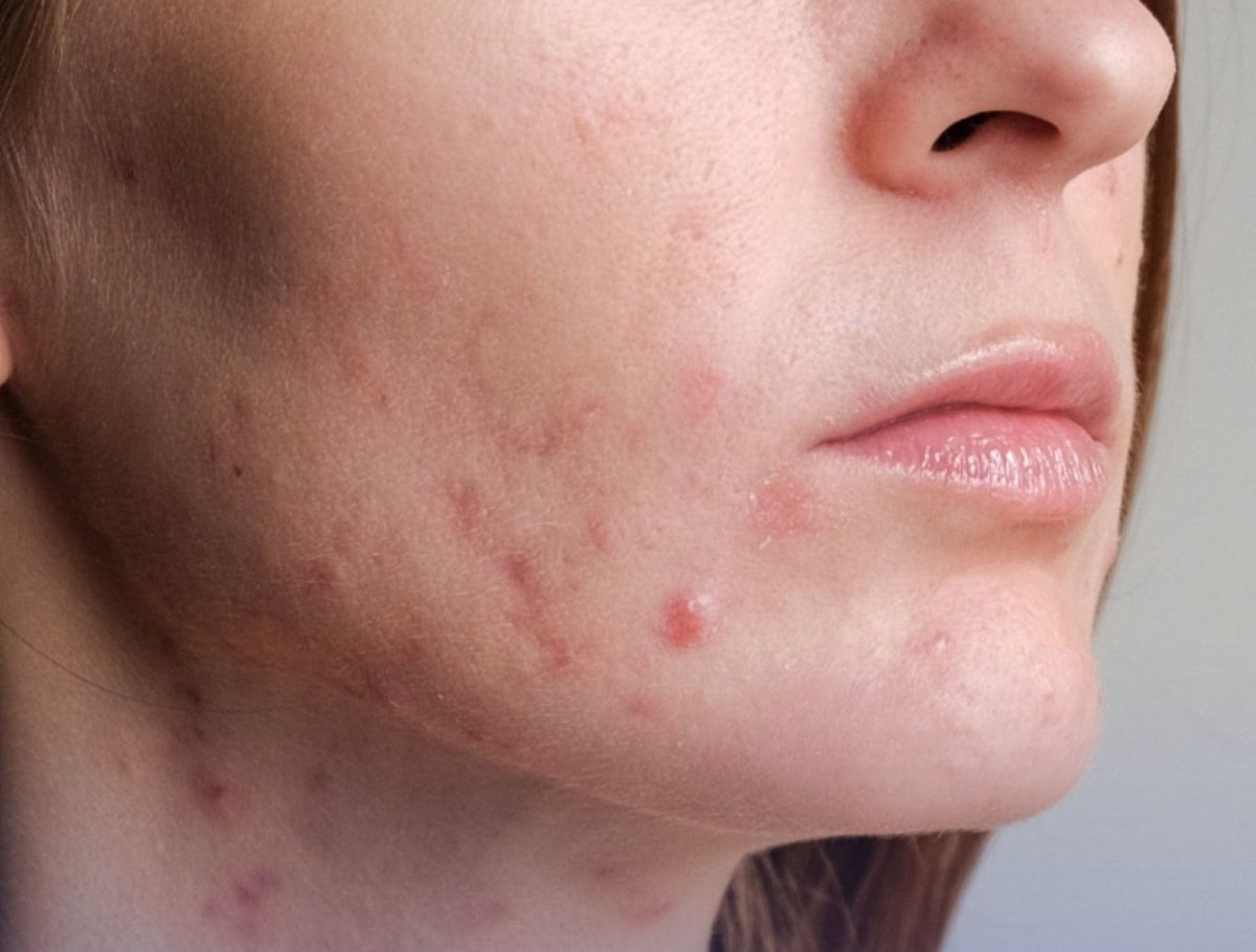 Acne Adulta