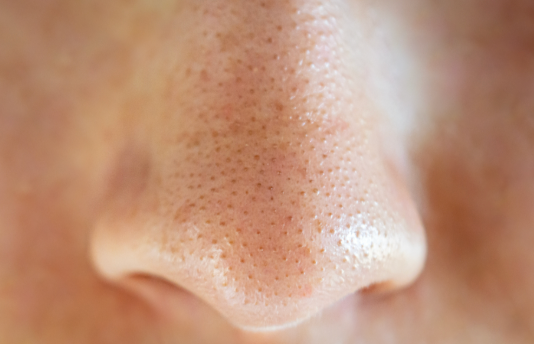 Prodotti Skincare per i Filamenti Sebacei